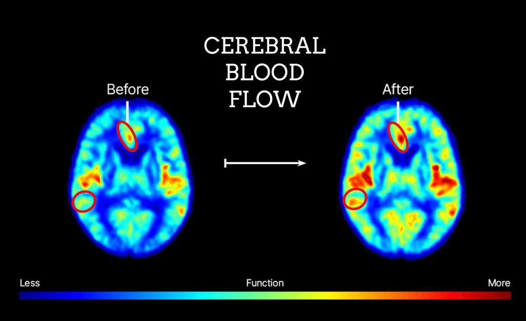 Cerebral blood flow